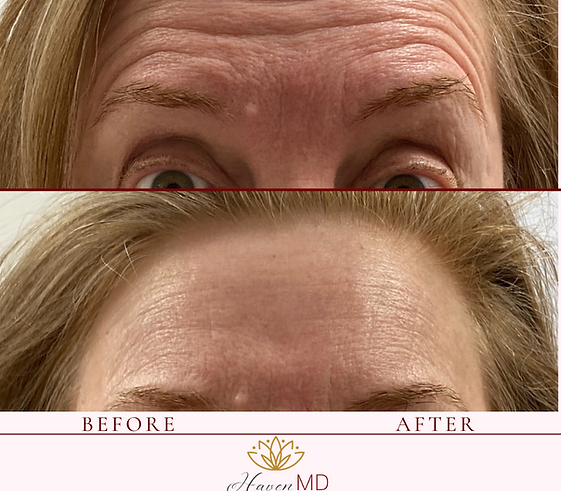 After & Before Botox Treatment